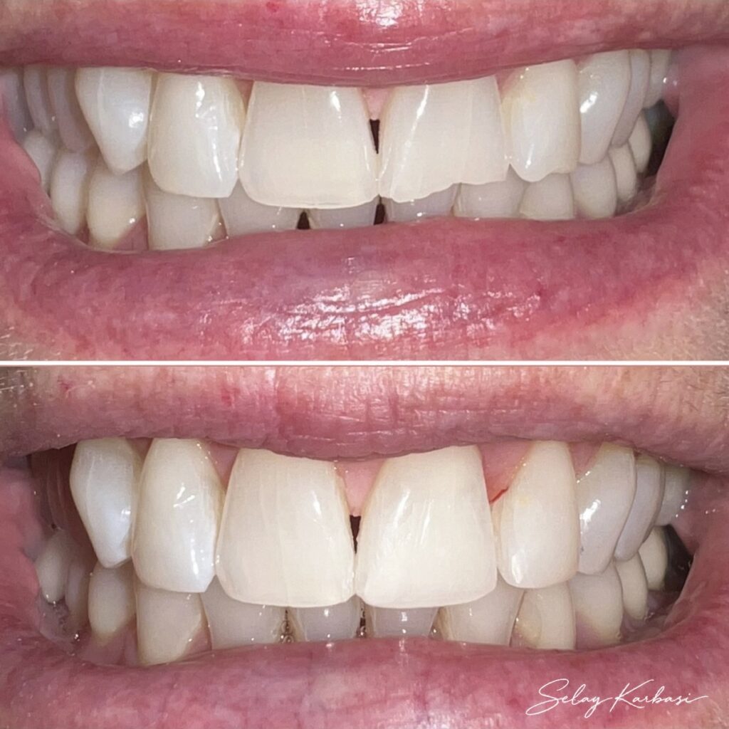 Before and after cosmetic bonding by Dr. Selay Karbasi at Dentistry at Grayhawk in Scottsdale, AZ: chipped front tooth edges repaired with tooth-colored bonding