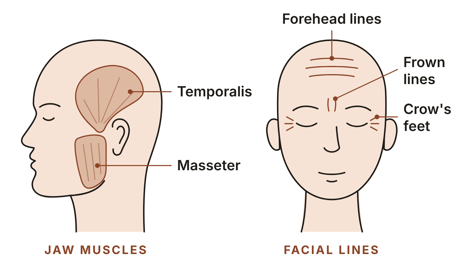 Left: a side view of a head showing the temporalis muscle at the temple and the masseter muscle at the jaw. Right: a face showing forehead lines, frown lines between the brows and crow’s feet beside the eyes.