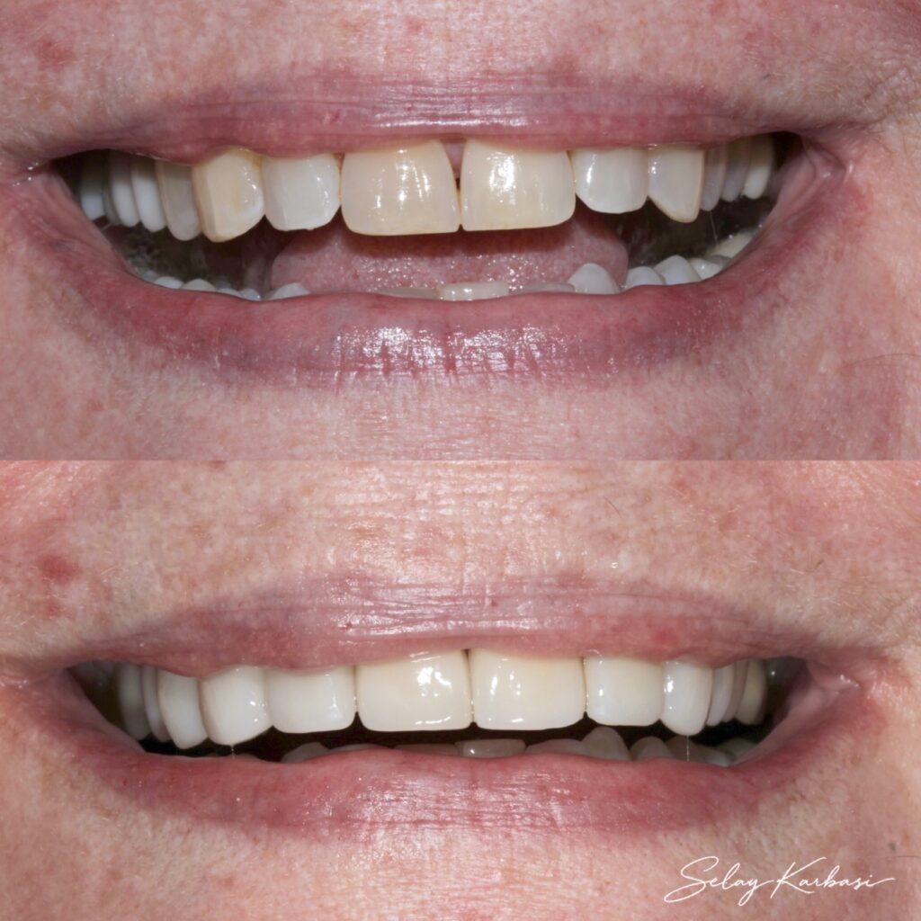 Before and after veneers by Dr. Selay Karbasi at Dentistry at Grayhawk in Scottsdale, AZ: gaps and uneven, yellowed upper teeth replaced with an even, brighter smile