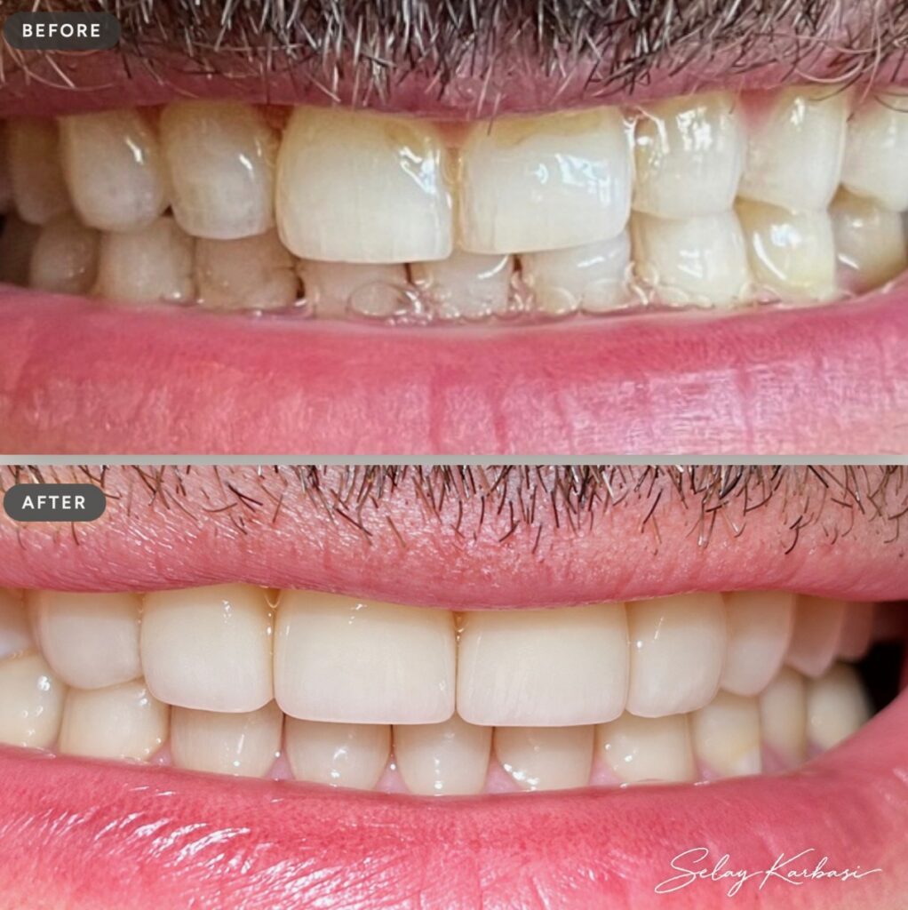 Before and after veneers by Dr. Selay Karbasi at Dentistry at Grayhawk in Scottsdale, AZ: worn, yellowed front teeth transformed into a uniform, brighter smile